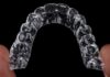 Ile kosztuje Invisalign w Polsce? Ile kosztuje Invisalign w Polsce?